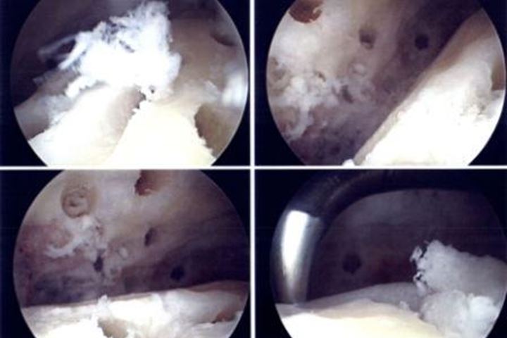 Arthroskopisch durchgeführte Versteifungsoperation des oberen Sprunggelenkes, das Gelenkinnere wird aufgerauht und angebohrt